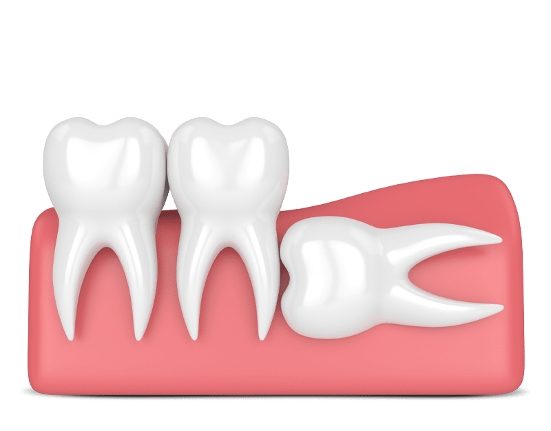complete bony impacted tooth graphic