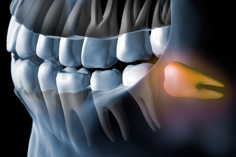 impacted wisdom teeth graphic